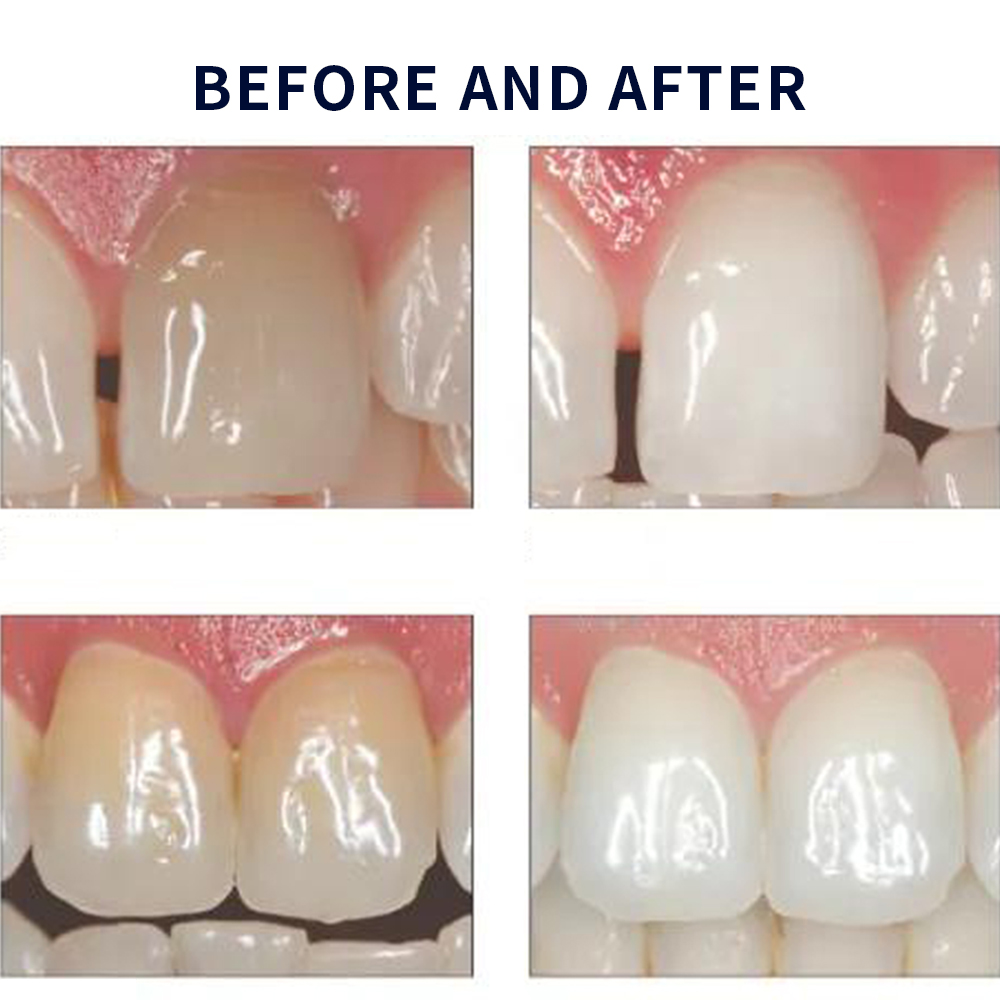 Opalwisdom-Kit de Blanchiment  - Teeth Whitening Bleaching Kit avis et prix