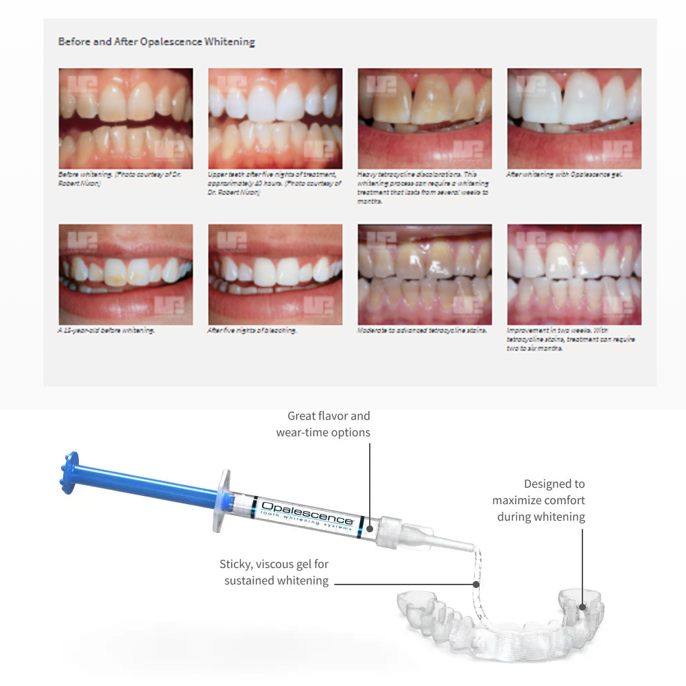 Opalwisdom-Kit de Blanchiment  - Teeth Whitening Bleaching Kit avis et prix