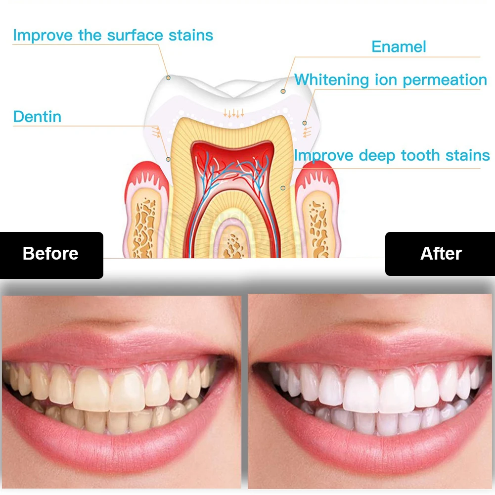 Kit de blanchiment des dents d - Teeth Whitening Bleaching Kit avis et prix